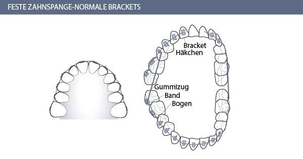 Zahnarzt Zürich Löwenplatz Graphik feste Zahnspange 