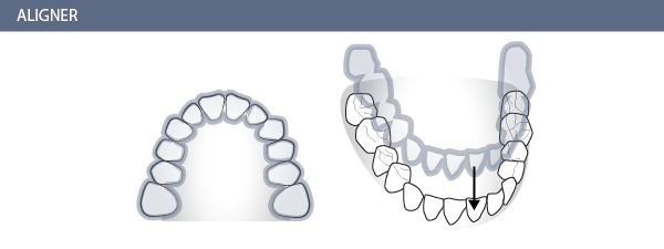 Zahnarzt Zürich Löwenplatz Graphik Invisalign Aligner 