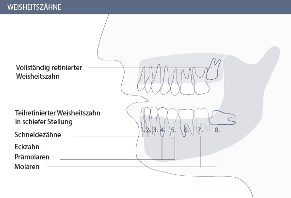Weisheitszahn OP Zürich Graphik 