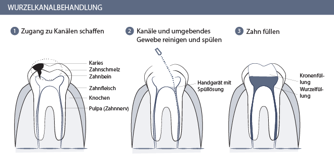 Wurzelbehandlung Zürich Graphik