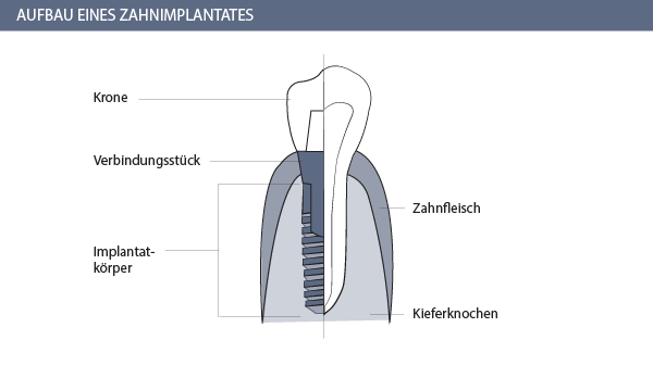 Zahnimplantat Aufbau Graphik - Zahnarzt Zürich 