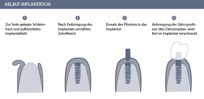 Ablauf Zahnimplantation Graphik - Zahnarzt Zürich 